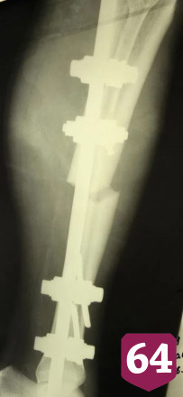 В Саратовской области культиватор раздробил пьяному мужчине ногу